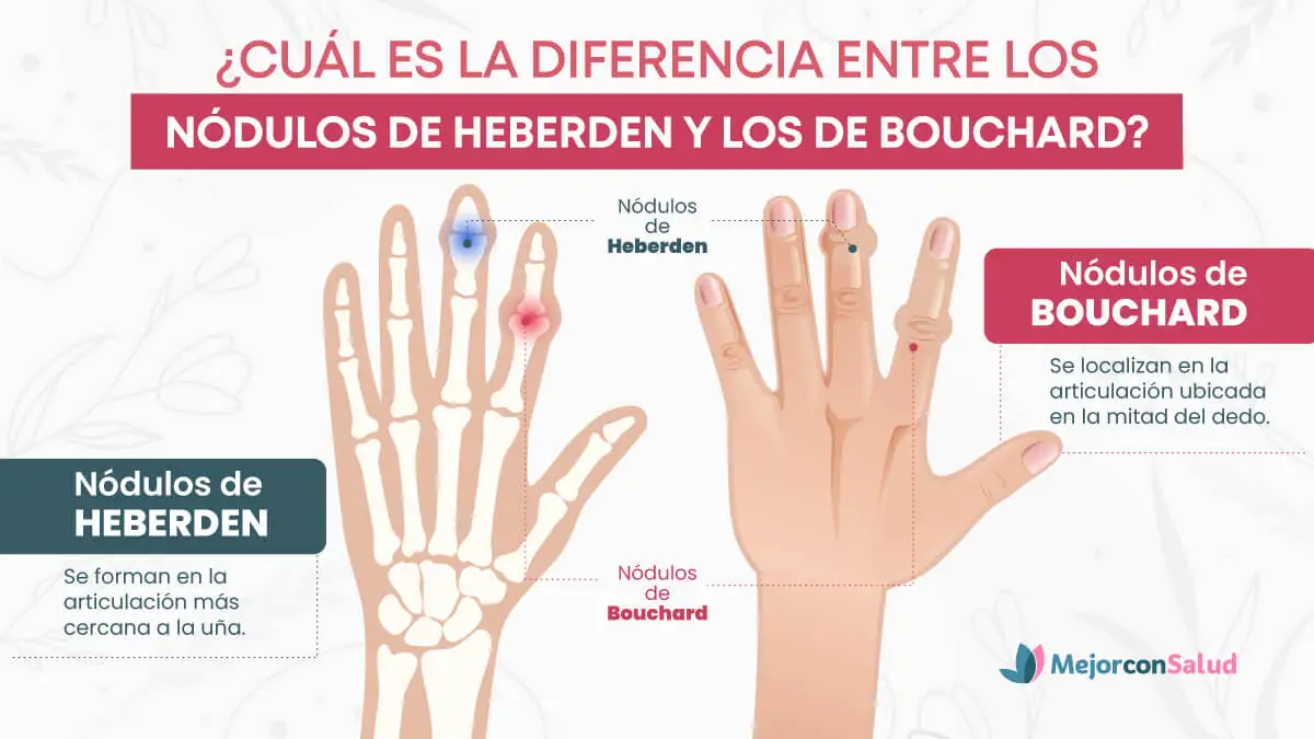 Nódulos de Bouchard: Todo lo que Necesitas Saber y Cómo Mejorar la Salud de Tus Articulaciones