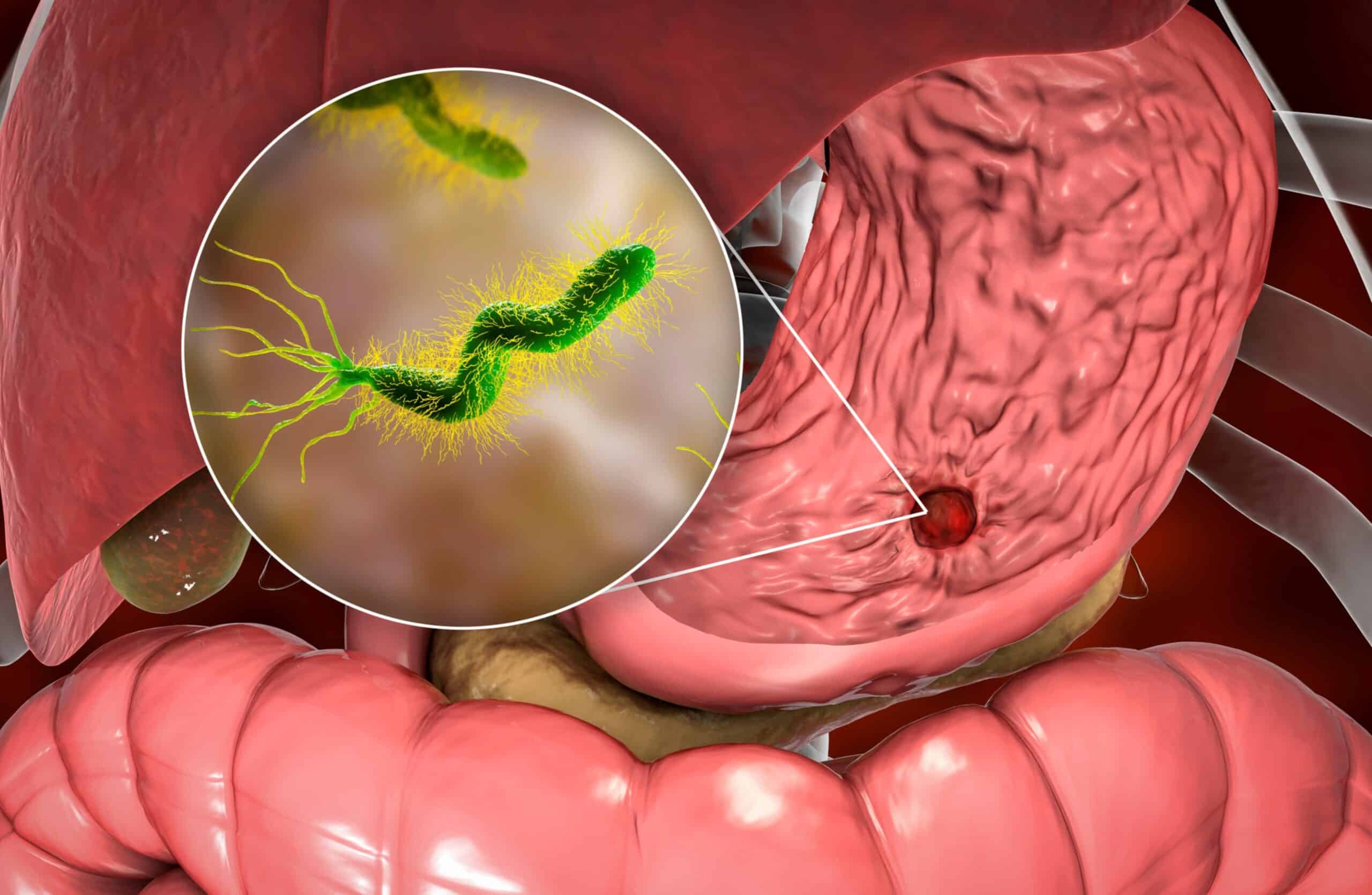 H. pylori y Cáncer de Estómago: La Conexión Sorprendente y Cómo Protegerte
